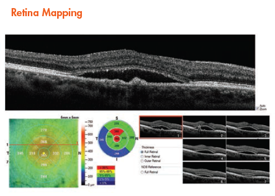 Optovue iScan 80 OCT – Optik Koherans Tomografi