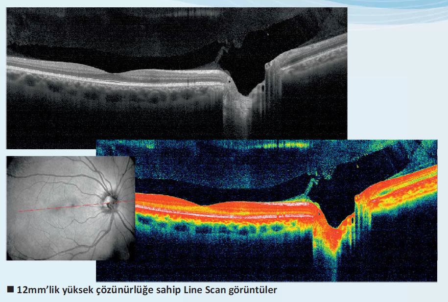 Optovue Angiovue OCT - Optik Koherans Tomografi